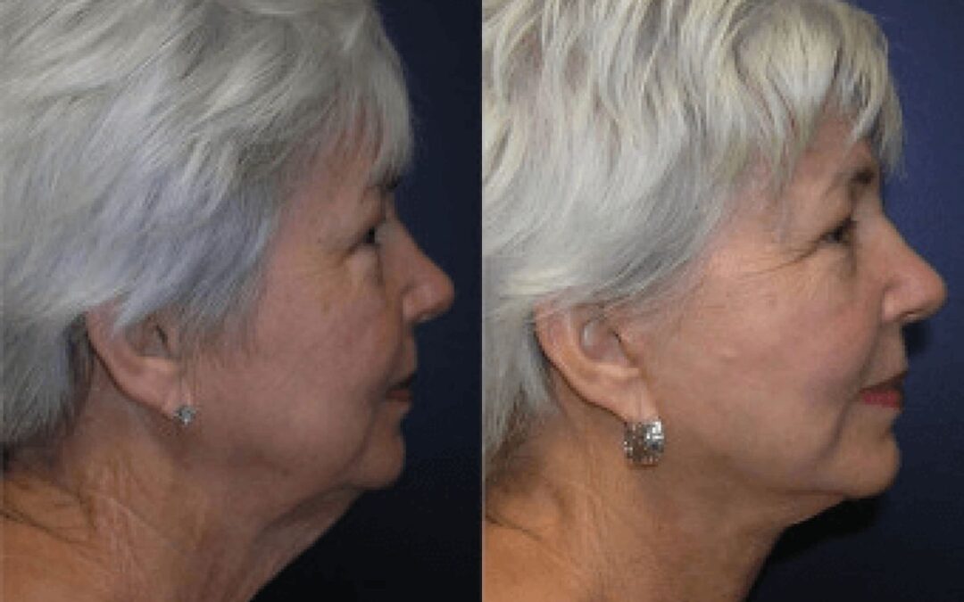 Face and Neck Lift #2