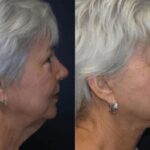 Face and Neck Lift #2 - Before and After