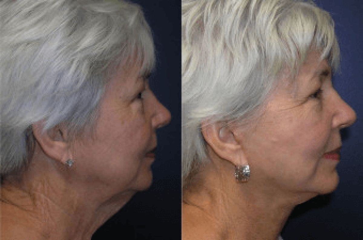 Face and Neck Lift #2 - Before and After