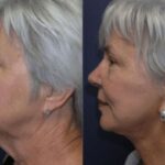 Face and Neck Lift #2 - Before and After