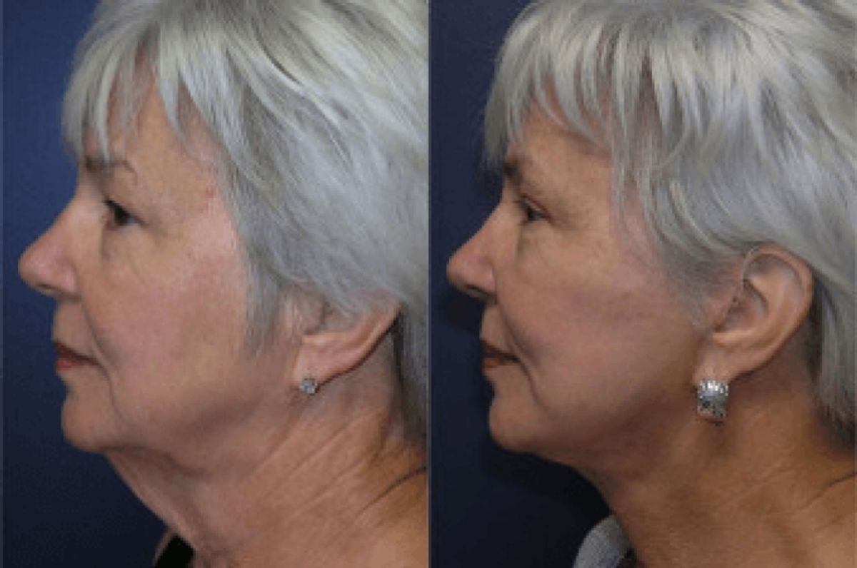 Face and Neck Lift #2 - Before and After