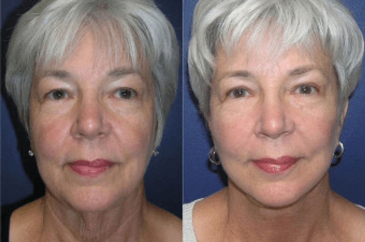 Face and Neck Lift #2 - Before and After