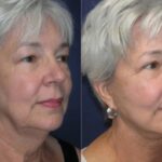 Face and Neck Lift #2 - Before and After