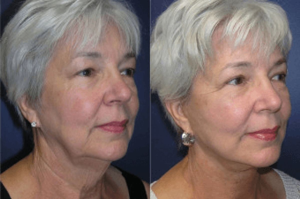 Face and Neck Lift #2 - Before and After