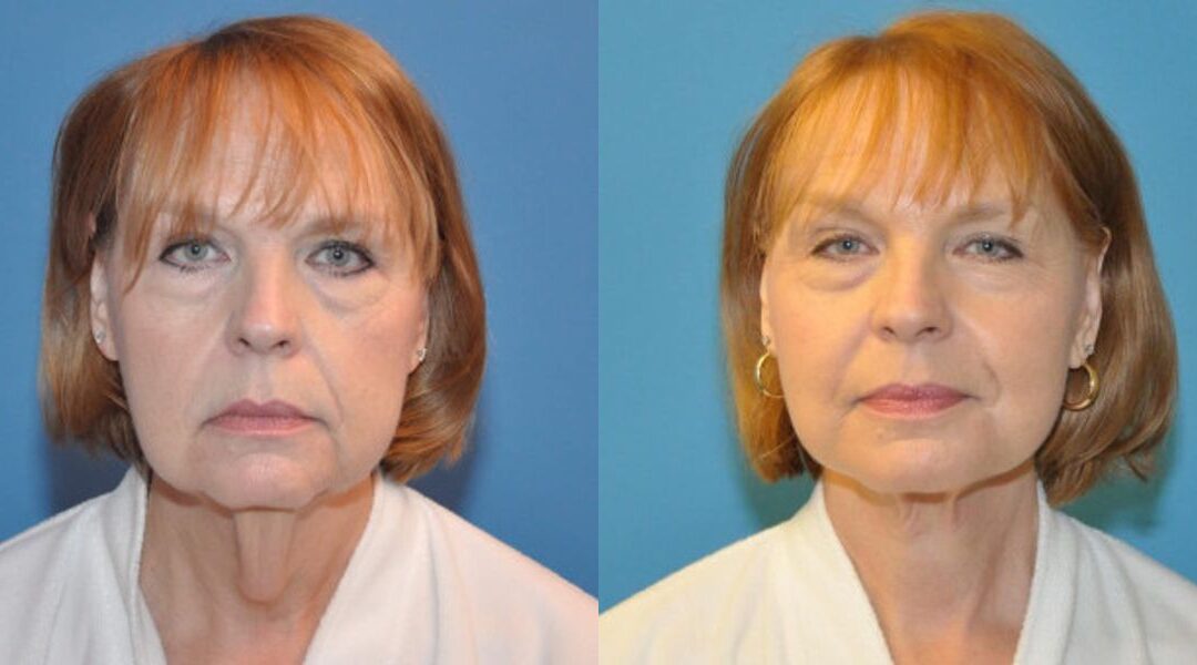 Face and Neck Lift #3