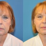 Face and Neck Lift #3 - Before and After