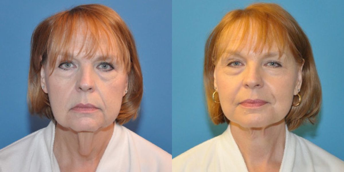 Face and Neck Lift #3 - Before and After