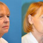 Face and Neck Lift #3 - Before and After