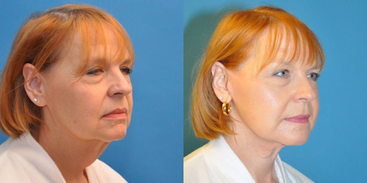 Face and Neck Lift #3 - Before and After