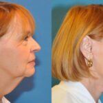 Face and Neck Lift #3 - Before and After