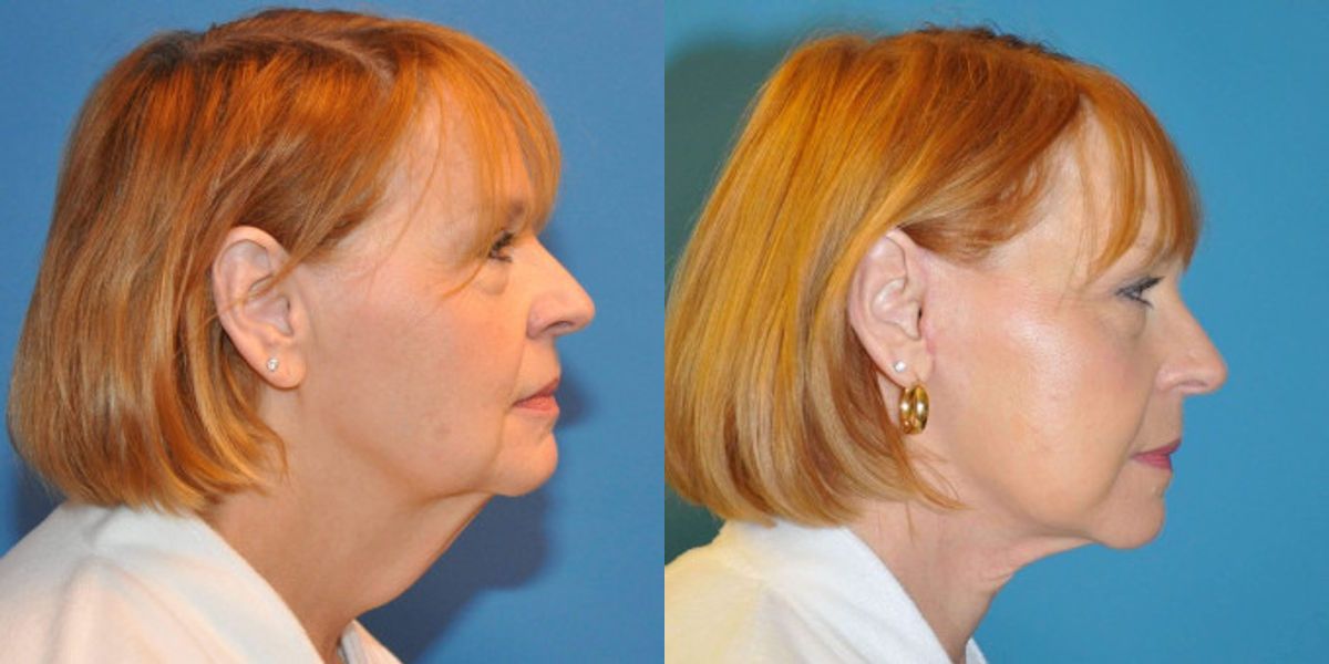 Face and Neck Lift #3 - Before and After