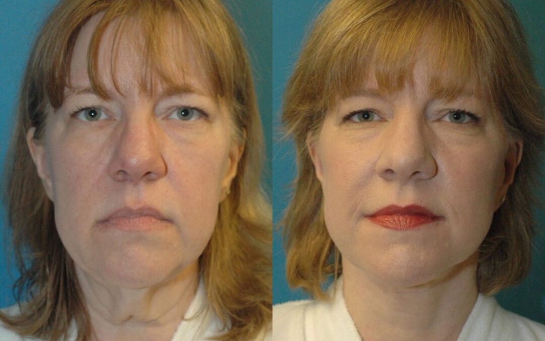 Face and Neck Lift #4