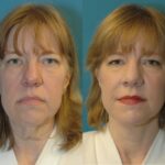 Face and Neck Lift #4 - Before and After
