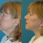 Face and Neck Lift #4 - Before and After