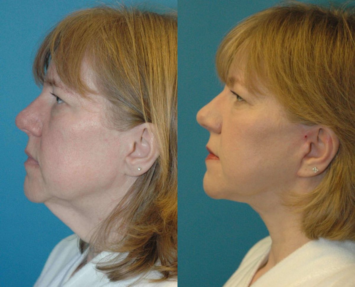 Face and Neck Lift #4 - Before and After