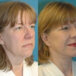 Face and Neck Lift #4 - Before and After