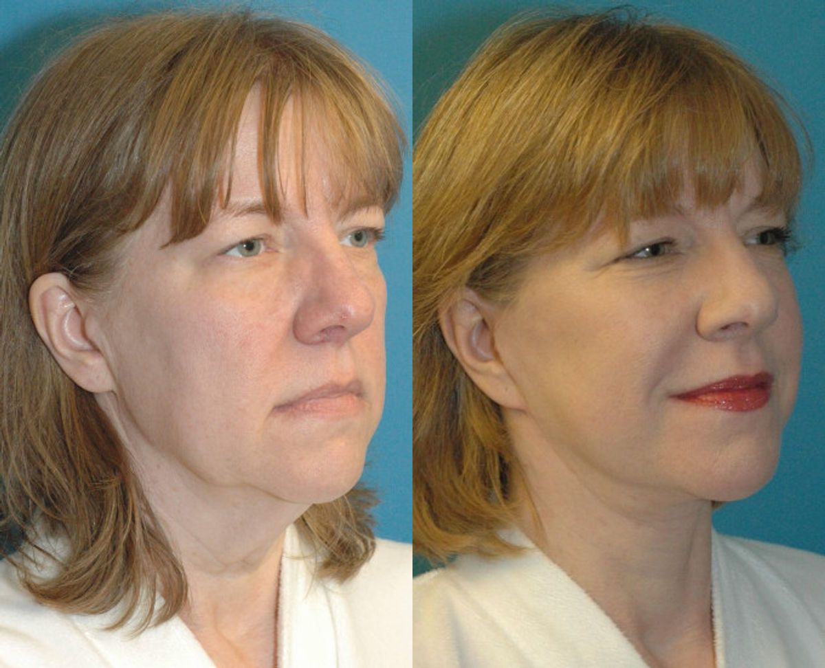 Face and Neck Lift #4 - Before and After