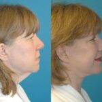 Face and Neck Lift #4 - Before and After