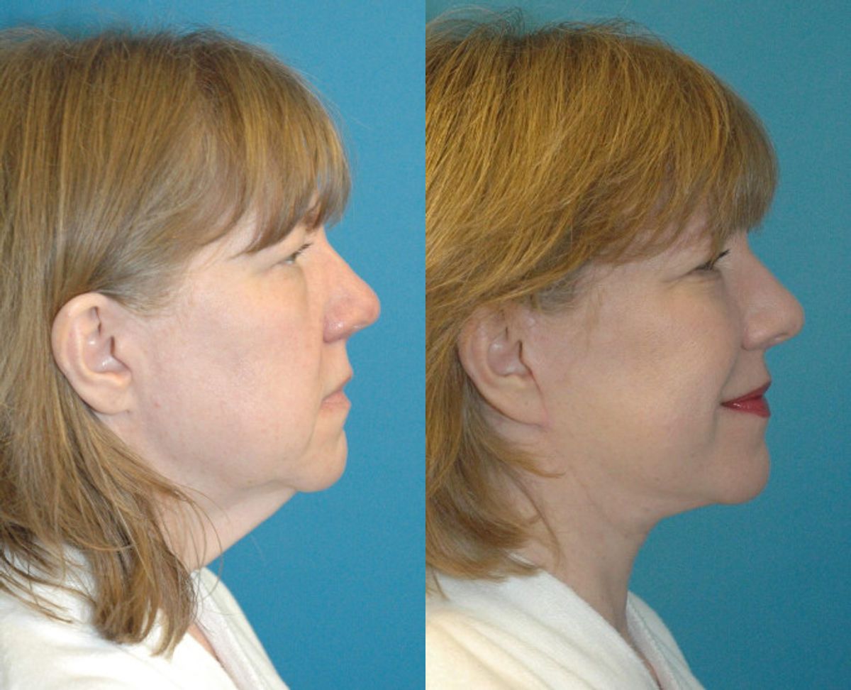 Face and Neck Lift #4 - Before and After