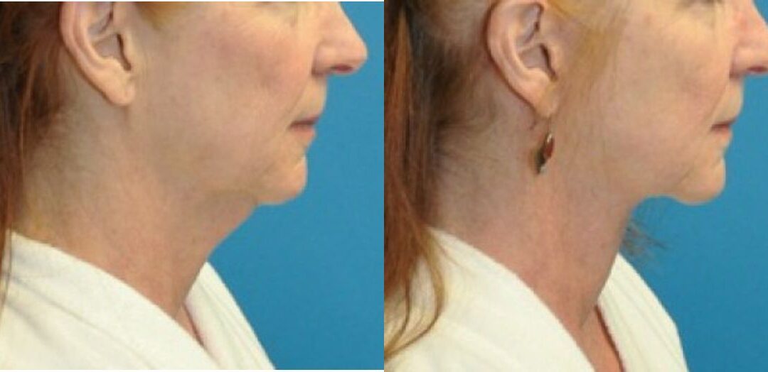 Face and Neck Lift #5