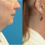 Face and Neck Lift #5 - Before and After