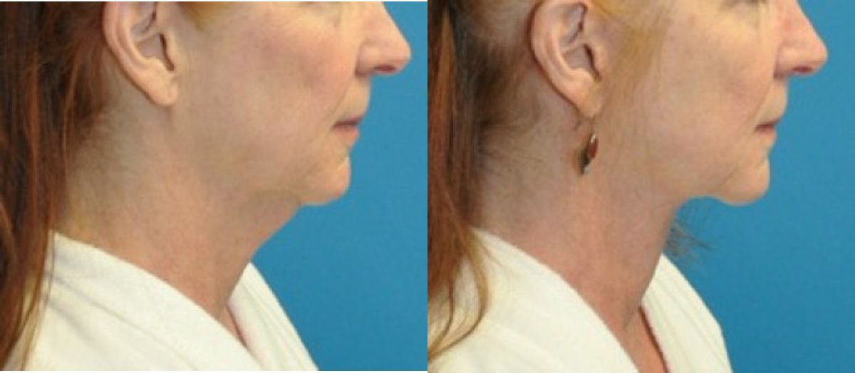 Face and Neck Lift #5 - Before and After