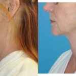 Face and Neck Lift #5 - Before and After