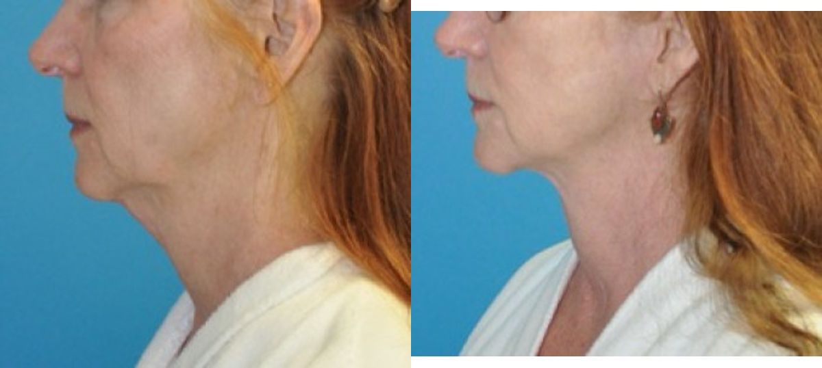 Face and Neck Lift #5 - Before and After