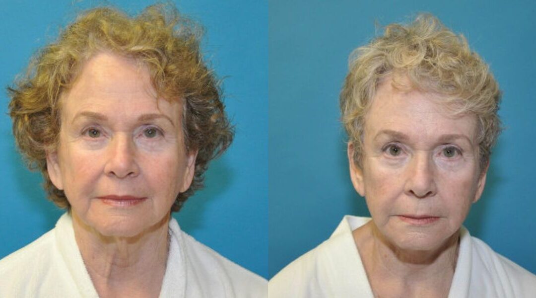 Face and Neck Lift  #7