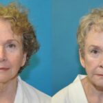 Face and Neck Lift  #7 - Before and After