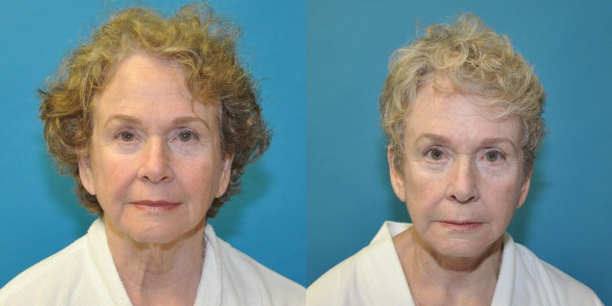 Face and Neck Lift  #7 - Before and After