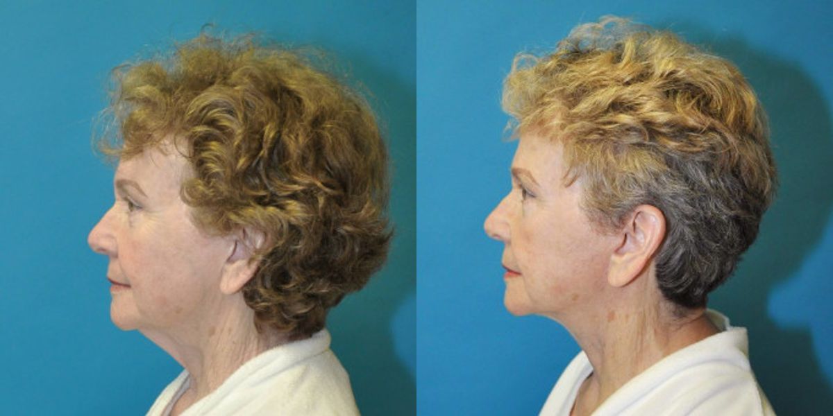Face and Neck Lift  #7 - Before and After