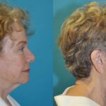 Face and Neck Lift  #7 - Before and After