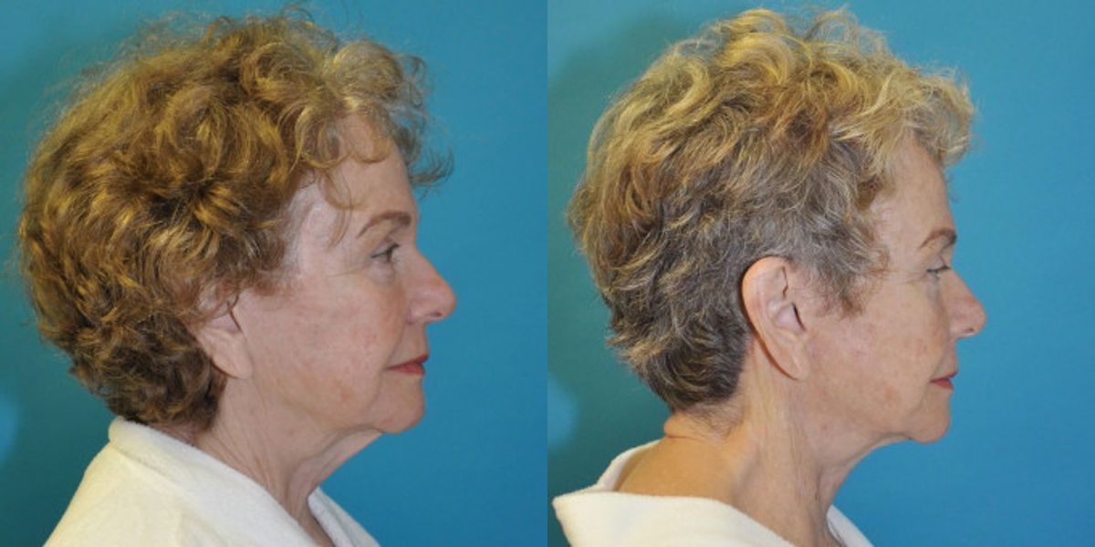 Face and Neck Lift  #7 - Before and After