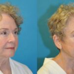 Face and Neck Lift  #7 - Before and After