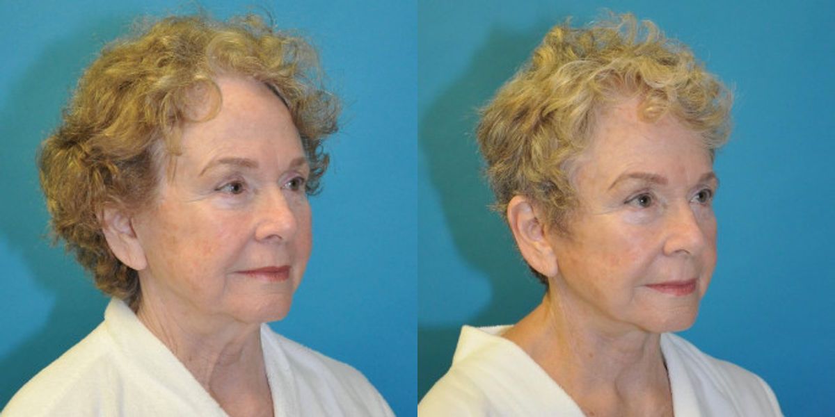Face and Neck Lift  #7 - Before and After
