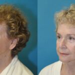 Face and Neck Lift  #7 - Before and After