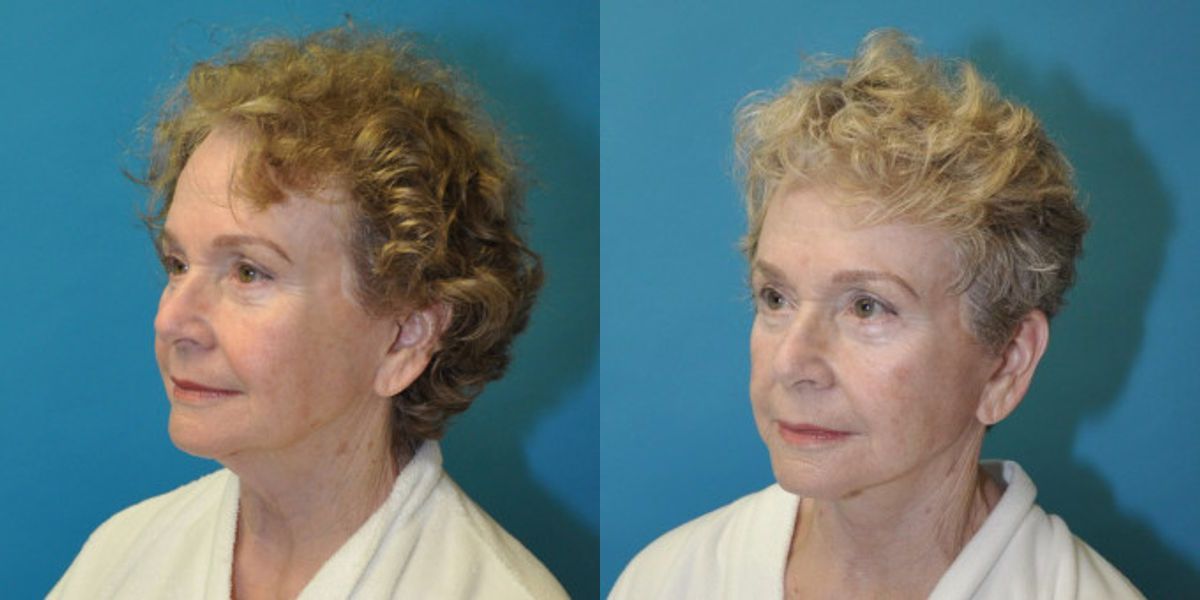 Face and Neck Lift  #7 - Before and After