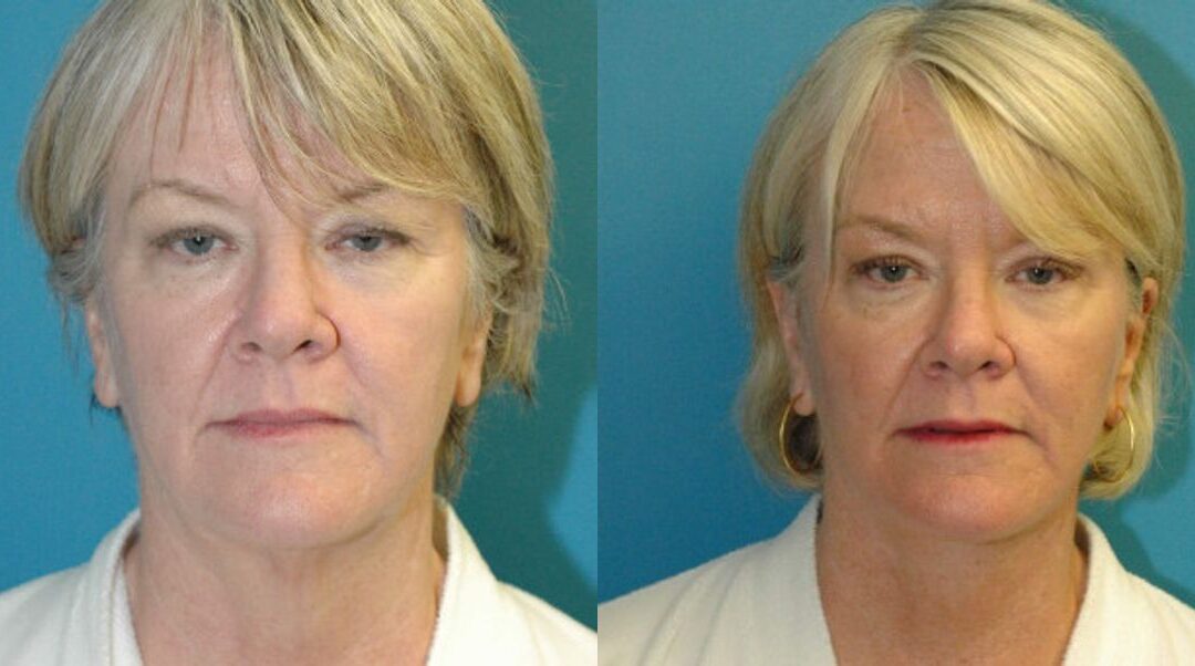 Face and Neck Lift # 8