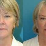 Face and Neck Lift # 8 - Before and After