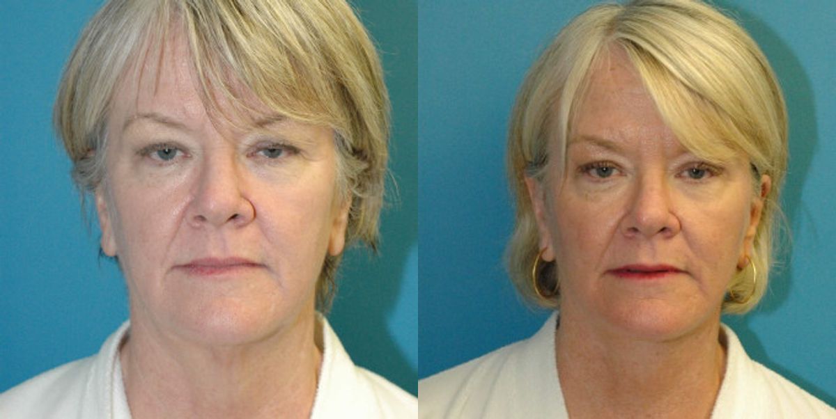 Face and Neck Lift # 8 - Before and After