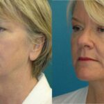 Face and Neck Lift # 8 - Before and After