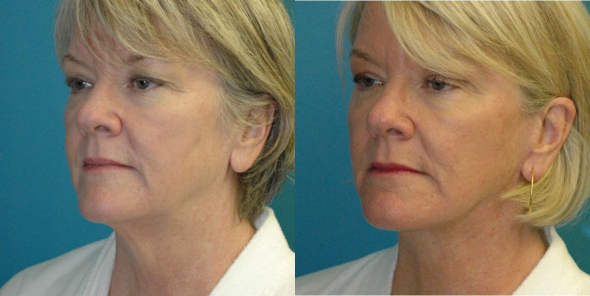 Face and Neck Lift # 8 - Before and After