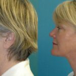 Face and Neck Lift # 8 - Before and After