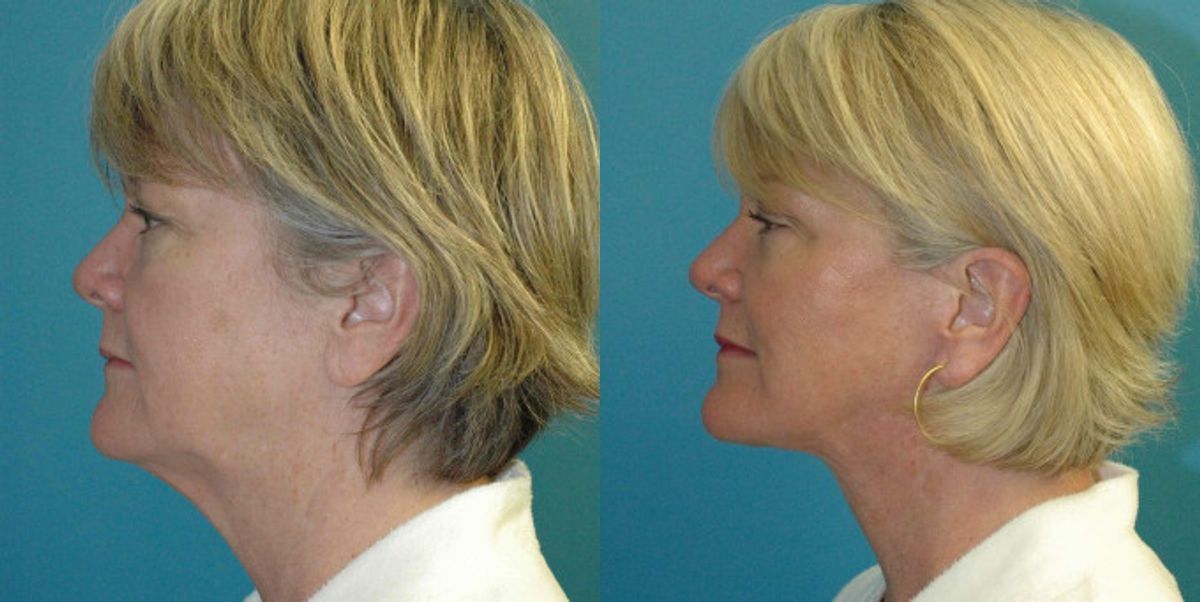 Face and Neck Lift # 8 - Before and After