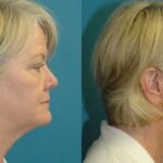 Face and Neck Lift # 8 - Before and After