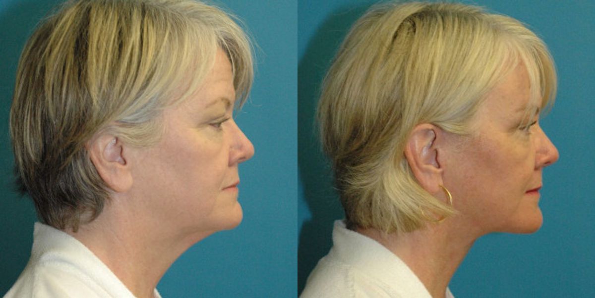 Face and Neck Lift # 8 - Before and After