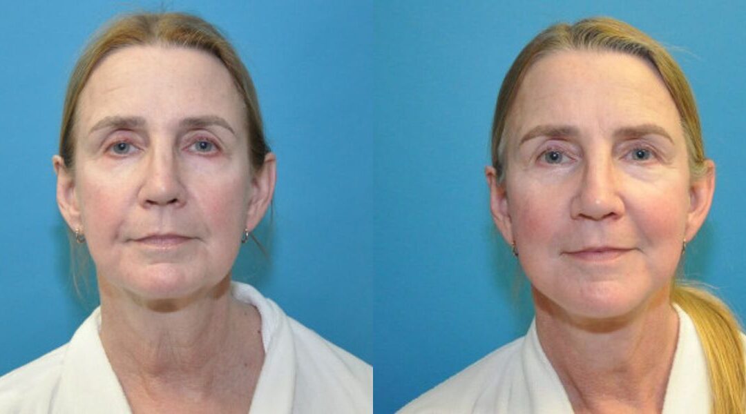 Face and Neck Lift  #9