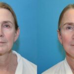 Face and Neck Lift #9 - Before and After