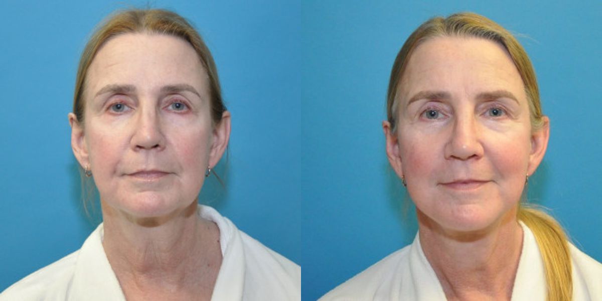 Face and Neck Lift #9 - Before and After